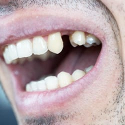 A patient with a missing front tooth, before treatment