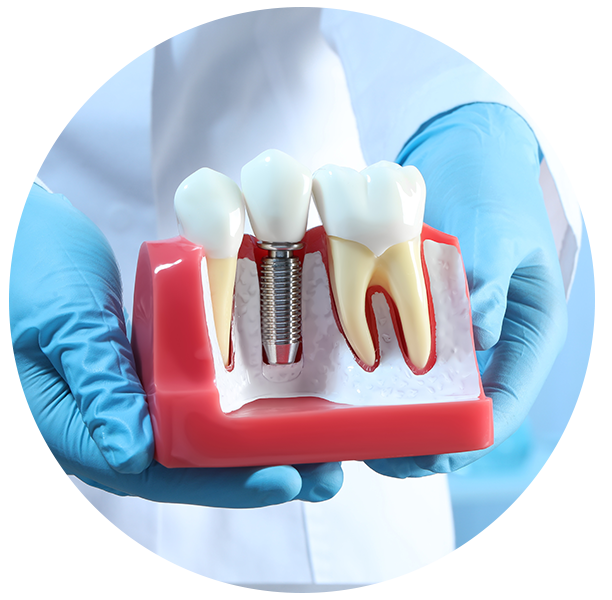 dental implant cost