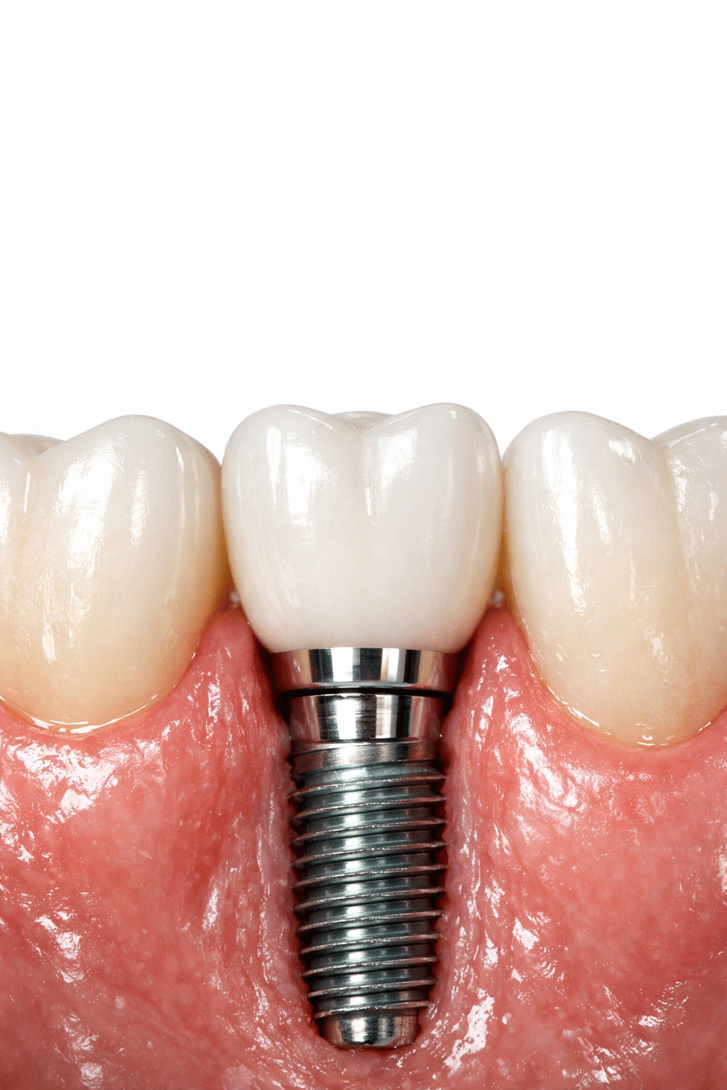 Dental-Implant Dental implant consultant
