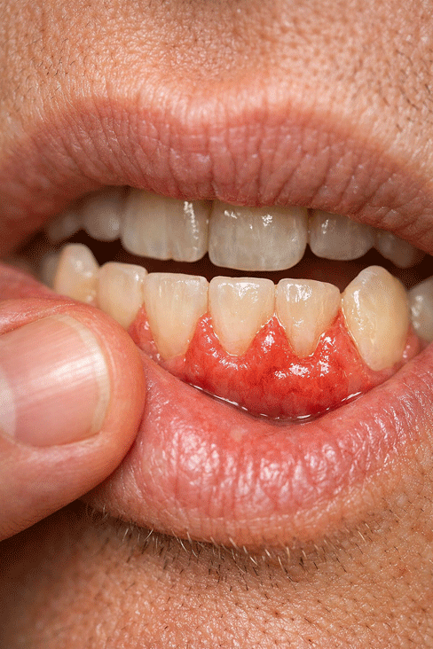 Gum-Disease Gum Infection Treatment Near Me